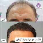 کلینیک کاشت مو آریان به روش SUT و HRT توسط دکتر صحراییان در شیراز