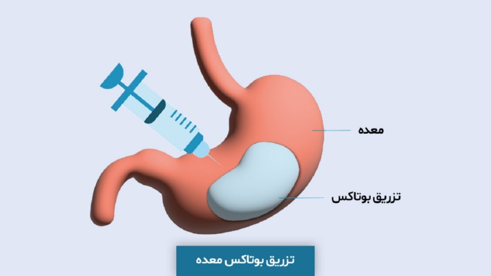 تزریق بوتاکس معده